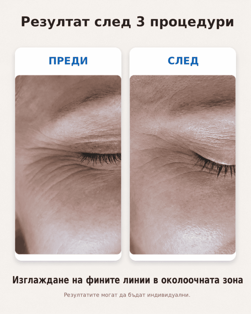 терапия със студена плазма в софия